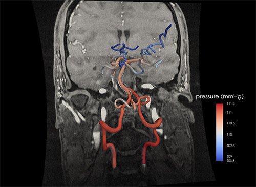 Computer model of cerebral arteries generated from CT scan.